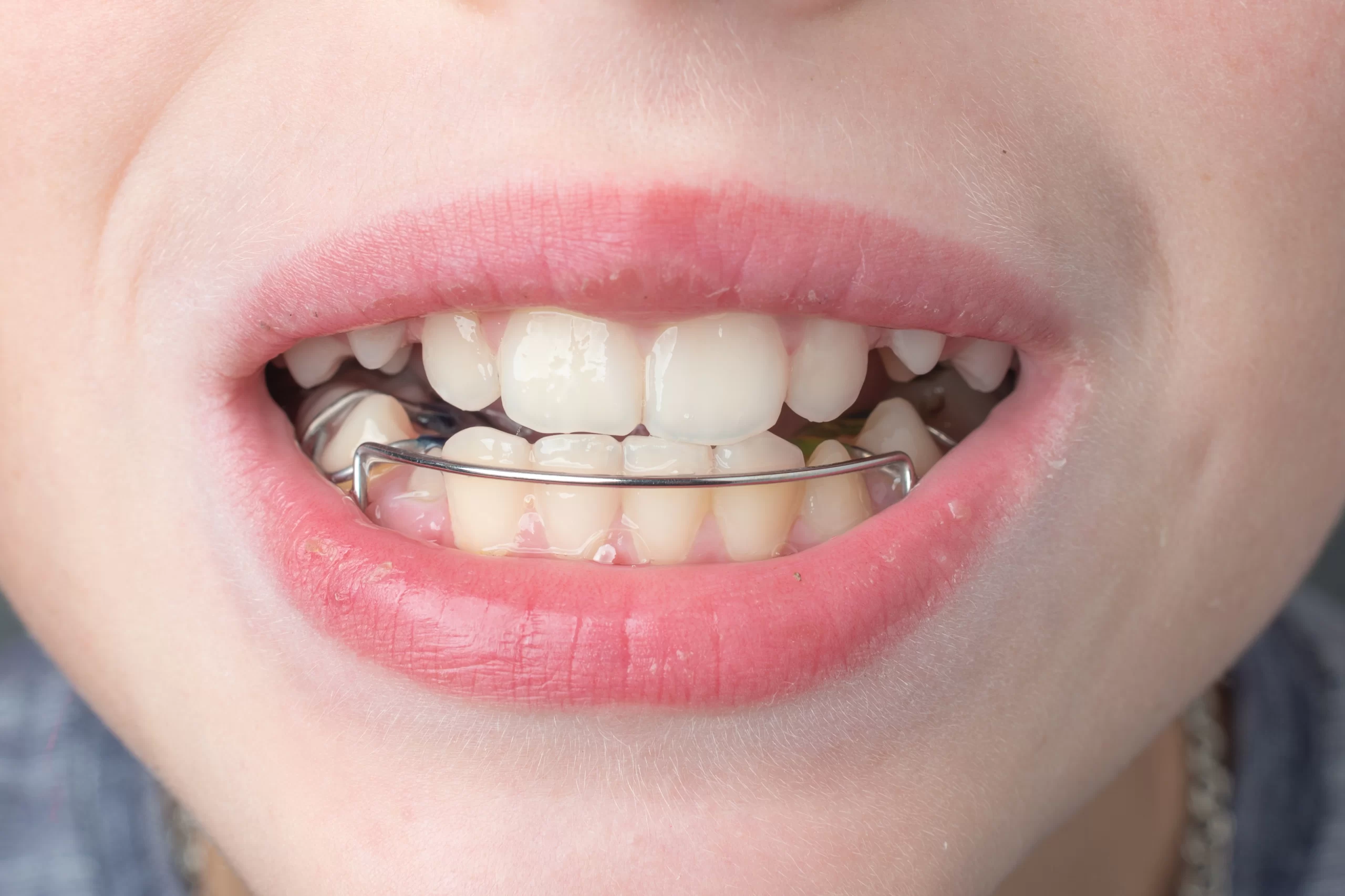  Benefits Orthodontic Treatment